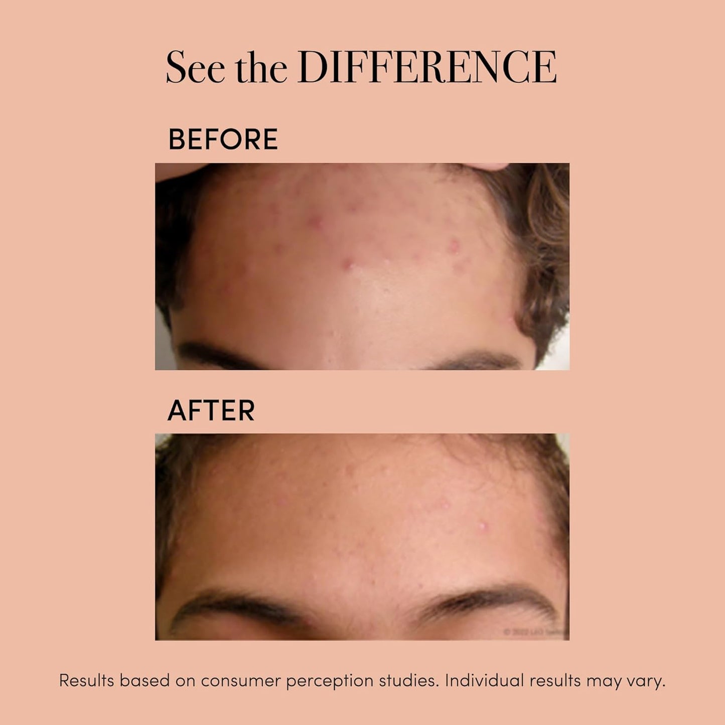 reVive Essentials Acne Device, FDA-cleared Red & Blue Light Acne Tools, Medspa Quality LED Light Therapy Products, Portable Triangular Design Face Tools for Skincare, Battery or USB Power