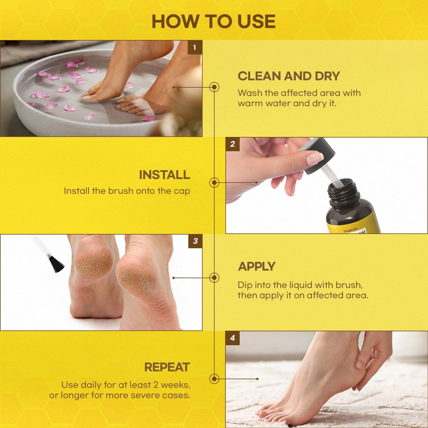 Fast-Acting bee Venom wart Remover: wart Freeze Off with salicylic Acid & bee Venom Cream - Wart Removal for Plantar Wart Genital Wart 18 ML