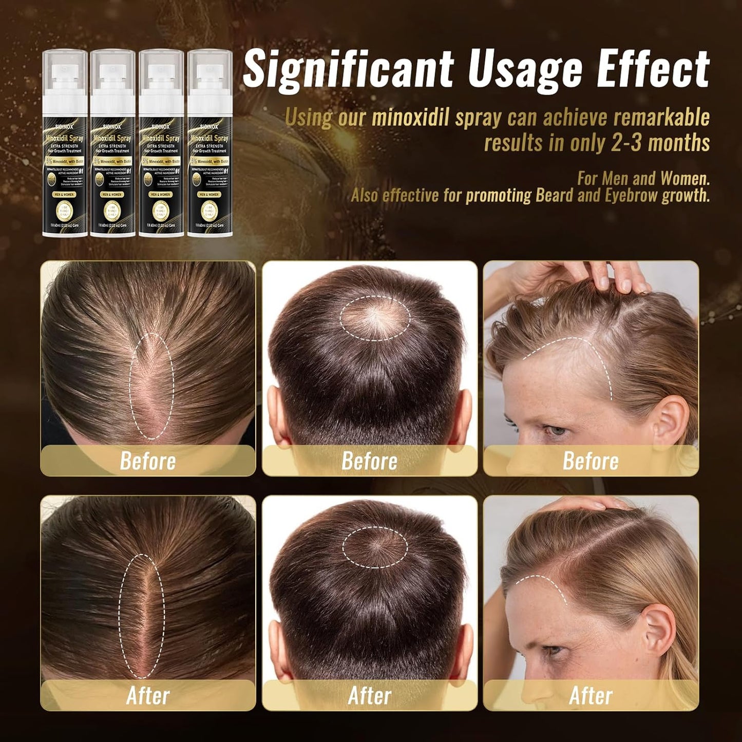 5% Minoxidil Spray for Men & Women (4 Month Supply)-Extra Strength Hair Growth Spray with Biotin & Castor Oil,Clinically Proven for Thinning Hair & Beard Regrowth, Non-Greasy Formula 4 pack（8.12 oz)