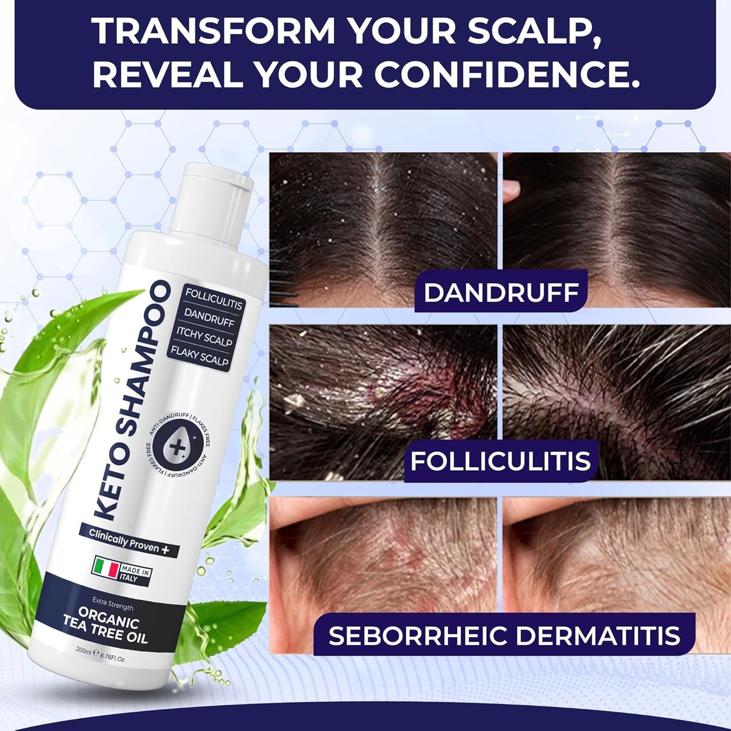 Scalp Psoriasis Shampoo, Flakes Shampoo Anti Dandruff, Itchy Scalp Treatment for Seborrheic Dermatitis & Folliculitis, Anti Fungal, Medicated Solution for Itchy, Flaky & Dry Hairs (Pack of 2)